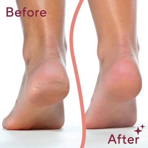 Rechargeable Electric Foot Callus Remover