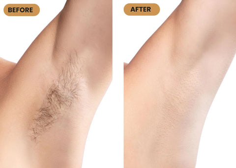 IPL Hair Removal Laser Epilator